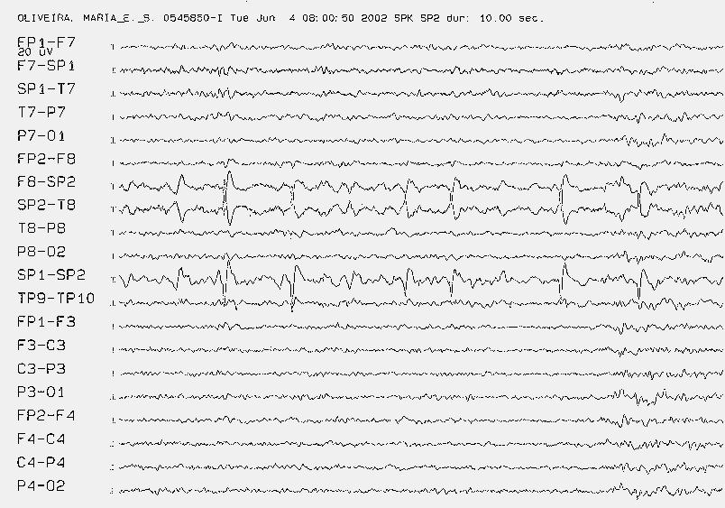 Figura: EEG de adulto com Epilepsia Temporal Mesial em sonolência, mostrando vários paroxismos epileptiformes (focos), tipo onda aguda, ponta e ponta-onda localizados em eletrodo especial, implantado