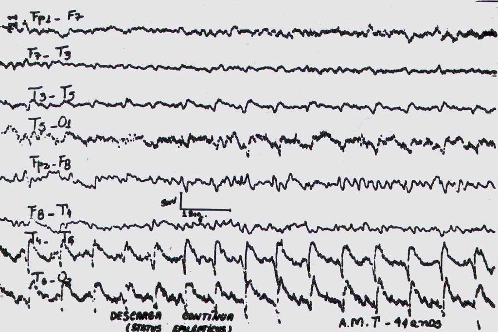 Quando ocorre uma crise epiléptica (chamado de ictus epilépticos), o EEG registra uma descarga paroxística geralmente rítmica, localizada ou generalizada, com uma duração bem maior, que corresponde à