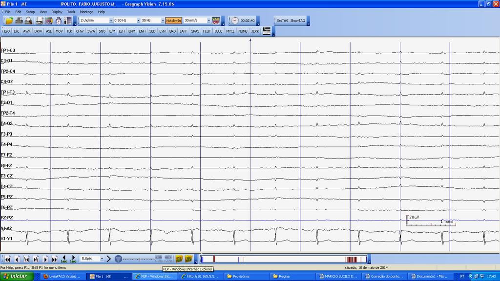 O EEG no diagnóstico de afecções não-epilépticas O EEG já foi muito mais indicado para investigar outras alterações neurológicas além da epilepsia, numa época em que os exames de neuroimagem eram