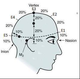 A captação dos sinais elétricos no escalpe é feita por eletrodos e seus cabos de condução, que captam e conduzem a atividade elétrica cerebral até o aparelho de EEG.