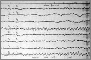 Para registrar a atividade elétrica, o aparelho de EEG registra a diferença de voltagem entre 2 eletrodos (E1-E2). A combinação desses 2 eletrodos para registro é denominada: canal ou derivação.