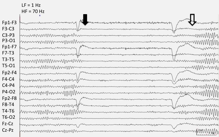 Então, uma linha no traçado do EEG vai sempre corresponder a Resposta: um canal ou derivação Para o registro de um EEG convencional usam-se vários canais simultâneos, em geral, 8 a 21 canais, que são