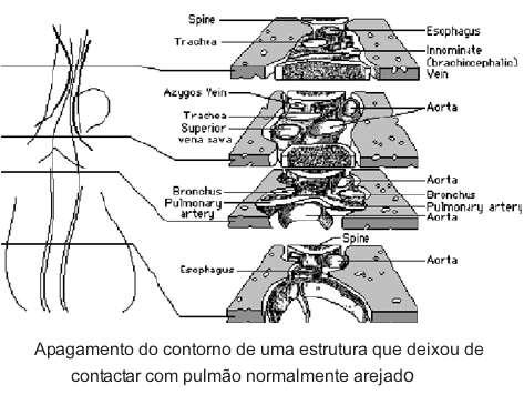 Sinal da Silhueta Permite localizar as alterações com