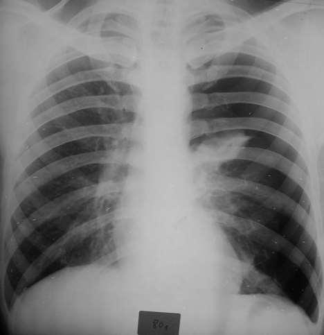 Patologia pleural Pneumotórax esquerdo Hipertransparência com ausência de retículo pulmonar, na metade externa do hemitórax esquerdo, limitada por linha de maior densidade internamente à qual se