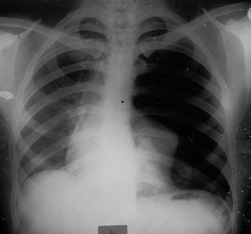 Patologia pleural Pneumotórax hipertensivo esquerdo Hipertransparência com ausência de retículo pulmonar, na metade externa do hemitórax esquerdo, limitada por linha de maior densidade