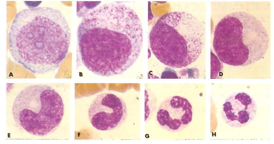 Leucocitose (superiores) Resposta da fase aguda de várias doenças Processos infecciosos e inflamatórios Leucemias Leucopenia (inferiores) Associada a uso de medicamentos como anti-inflamatórios,