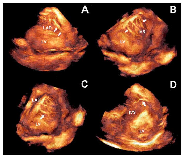 Fig. 1.5 Perfusão cardíaca de um paciente com hipertrofia cardiomiopática utilizando Ecocardiografia tridimensional e contraste de microbolhas.