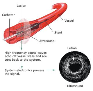 IVUS