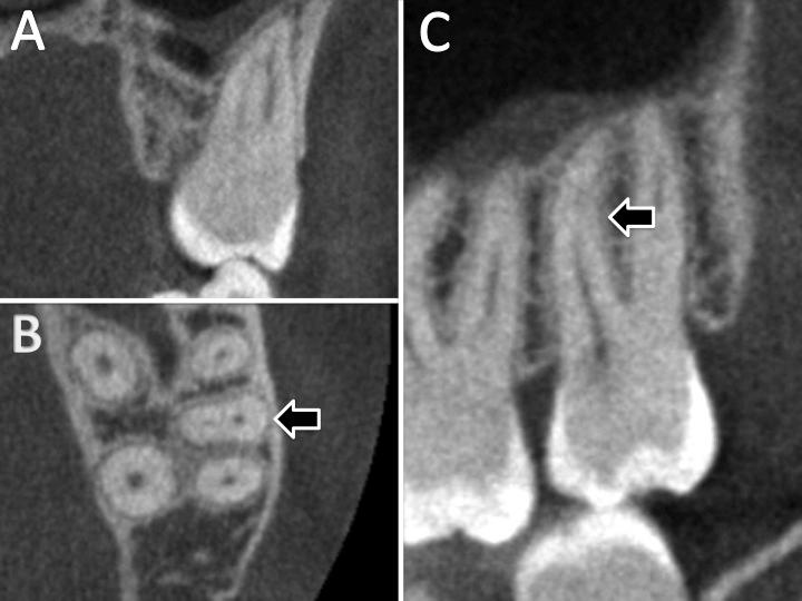 58 Para o segundo molar superior foram observadas 886 tomografias, totalizando 1092 dentes observados. Os resultados mostraram que 97,8% apresentaram três raízes e 2,2% apresentaram uma única raiz.