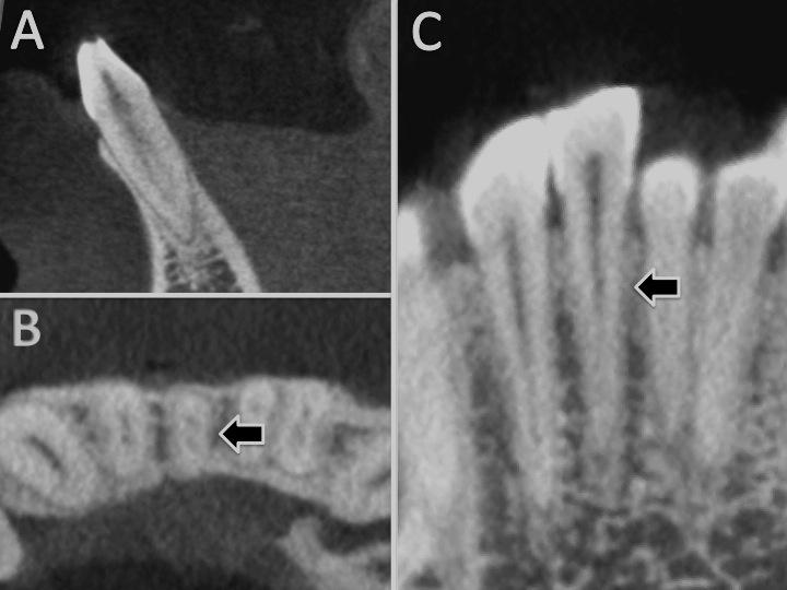 61 Para o incisivo central inferior foram observadas 847 tomografias, totalizando 1412 dentes observados Os resultados mostraram que 100% dos casos apresentaram uma única raiz.