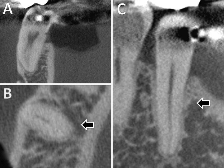 69 Para o segundo pré-molar inferior foram observadas 831 tomografias, totalizando 1285 dentes observados.