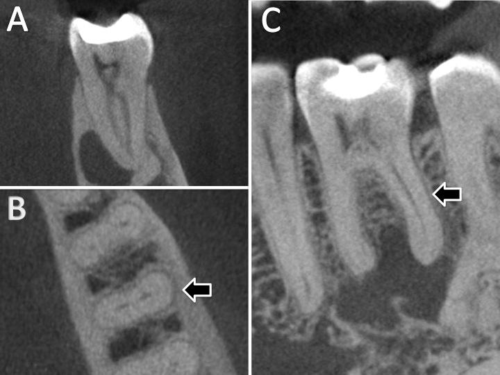 71 Para o primeiro molar inferior foram observadas 851 tomografias, totalizando 1190 dentes observados.