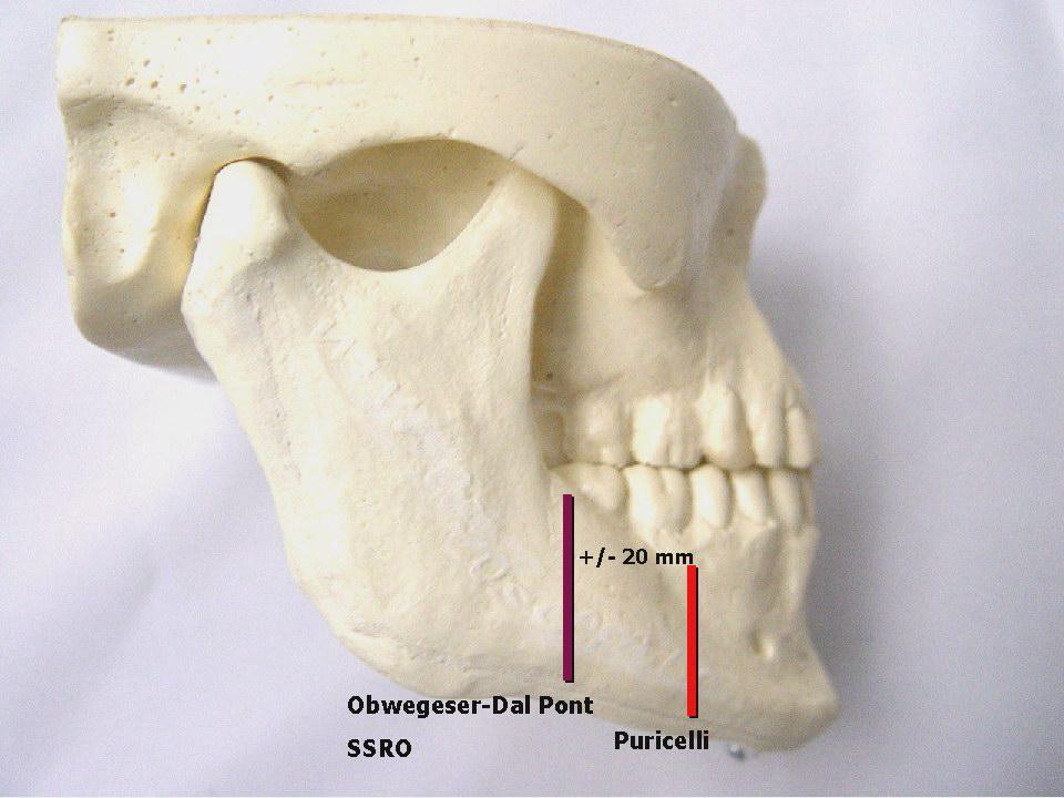 13 3.3.5 Osteotomia sagital Puricelli No Brasil, uma modificação importante da osteotomia sagital foi realizada por Puricelli em 2007, entretanto a técnica já era empregada desde 1985.