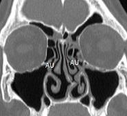 anterior, defeito da lâmina papirácea ou sua medialização, grau de pneumatização do seio frontal, pneumatização da crista galli, simetria da fossa olfativa, altura da lamela lateral, localização do