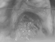 coloração semelhante à mucosa, assintomática, apresentando base pediculada voltada para a região ântero-superior (Fig. 2 e 3). Fig.
