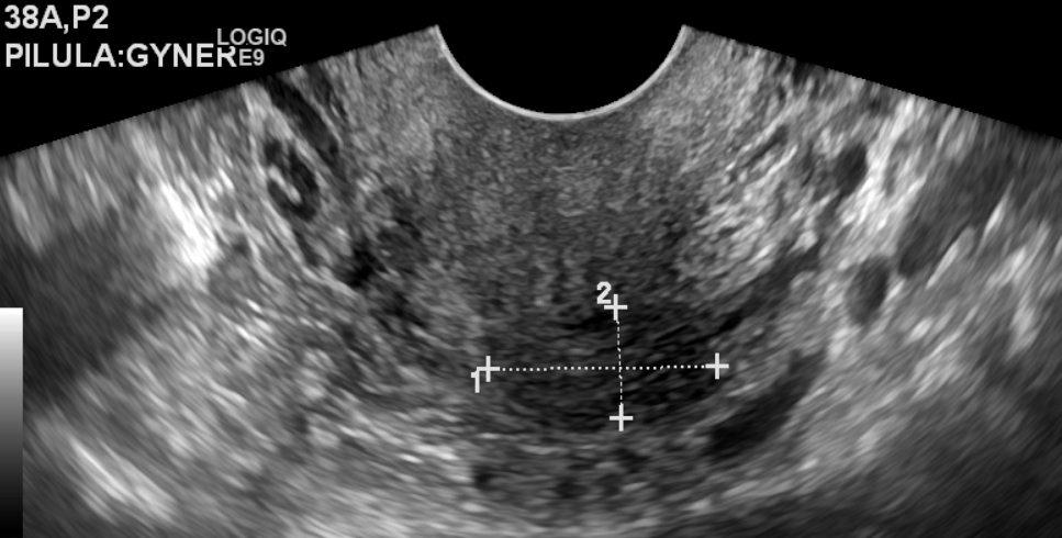 Fig. 6 - Mulher de 45 anos com queixas de algias pélvica.