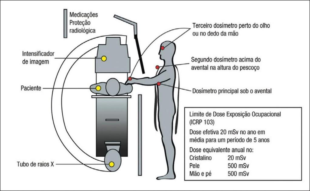 73 de até 500 msv para pele e extremidades (mãos e pés) e no máximo 20 msv para o cristalino.