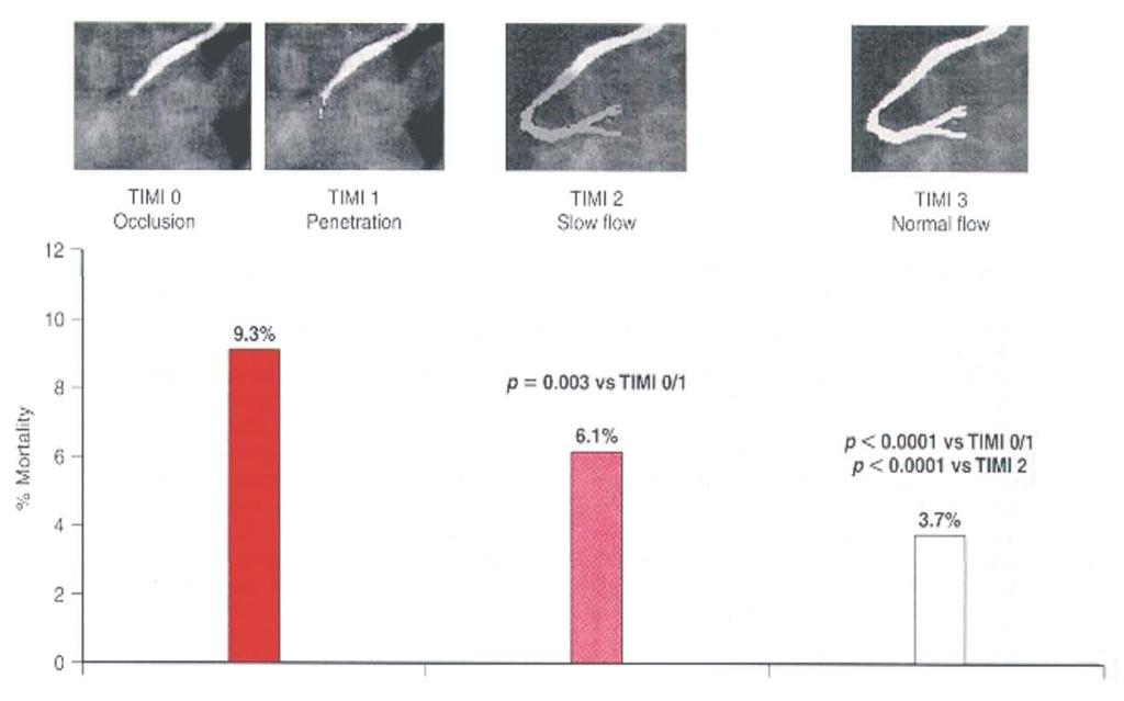 Reperfusão: Consequências TIMI 0 Oclusão TIMI 1 Penetração TIMI 2 Fluxo lento TIMI 3 Fluxo normal 9,3%