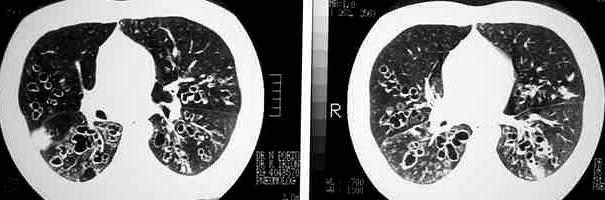 As evidências para intervenções terapêuticas nas bronquiectasias, salvo nos casos de Fibrose Cística, são muito