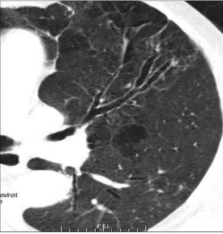 pulmonar adjacente A. IBA>1. Áreas de aprisionamento aéreo e áreas de bronquiectasias. B. IBA normal.