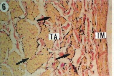 Veias de Grande Calibre T. Íntima bem desenvolvida, pode apresentar membrana elástica interna. T.Média delgada T.