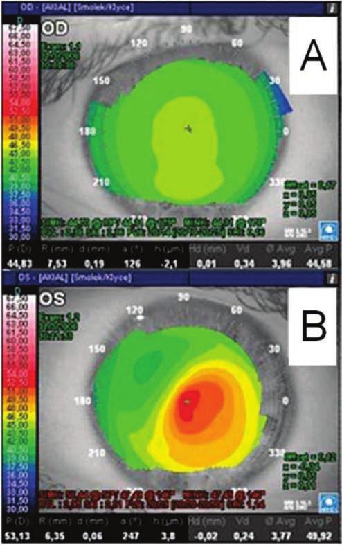 304 Valbon BF, Salomão M, Ramos I, Canedo AL, Nogueira L, Ambrósio Jr R Figura 1: Topografia corneana do OD não observamos alterações e/ ou índices topográficos para ceratocone e/ou ectasia Figura 2: