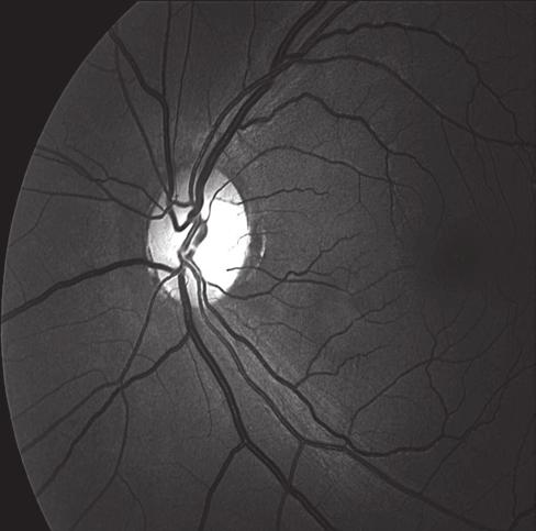 Avaliação da camada de fibras nervosas da retina nas afecções neuroftalmológicas da via óptica anterior 135 Figura 8: Fotografia do fundo de olho de paciente com hemianopsia temporal e atrofia em