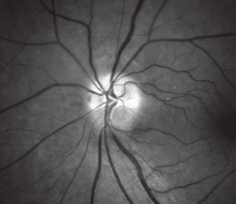 Avaliação da camada de fibras nervosas da retina nas afecções neuroftalmológicas da via óptica anterior 131 Figura 5: Palidez e perda da camada de fibras nervosas no setor superior do disco óptico