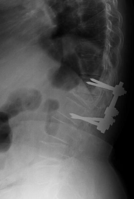 De entre o total de doentes com que se iniciou o estudo foram seleccionados aqueles em que estavam disponíveis registos radiológicos nos 30 dias após a cirurgia, constituindo o Grupo 1.