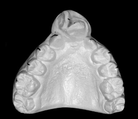 Avaliação da angulação e inclinação dos elementos dentários em pacientes adultos jovens portadores de fissura transforame incisivo bilateral dos valores médios,