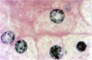 Figura 2.31 - Células da suprarrenal (ou adrenal), cujo citoplasma eosinófilo se deve à riqueza em retículo endoplasmático liso e mitocôndrias para a síntese de hormônios esteroides.