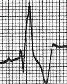 CRITÉRIOS ECG NOS GRUPOS CONTROLE Surawicz B, et al. J Am Coll Cardiol. 2009; 53: 976-981 1.