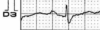 Nome: LVD Idade: 27 Gênero: Masculino Grupo étnico: Caucasiano Peso: 69kg Altura:1,70m PLANO FRONTAL Eixo QRS = -46 AFC Eixo P: +64 ; Eixo QRS: -46 ; Eixo T +60 T X RAH Y SIII<SII