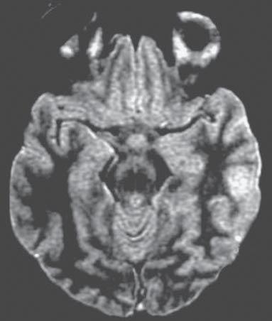 Ferreira CS et al. Figura 7. RM seqüência ponderada em T2 (), corte axial, mostrando pequena área de hipersinal cortical no lobo temporal esquerdo compatível com edema ou infarto (setas).
