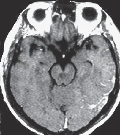 RM seqüência ponderada em T1 sem contraste, corte coronal () mostrando infarto hemorrágico córtico-subcortical no lobo frontal esquerdo. O seio sagital superior apresenta sinal normal (seta).