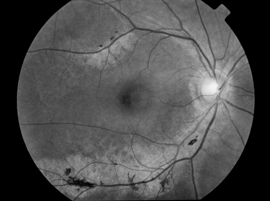 Atrofia Retinocoroideia Pigmentada Paravenosa: A propósito de um caso clínico ao longo das veias retinianas, nas arcadas vasculares até à periferia da retina (Figs. 1 e 2).