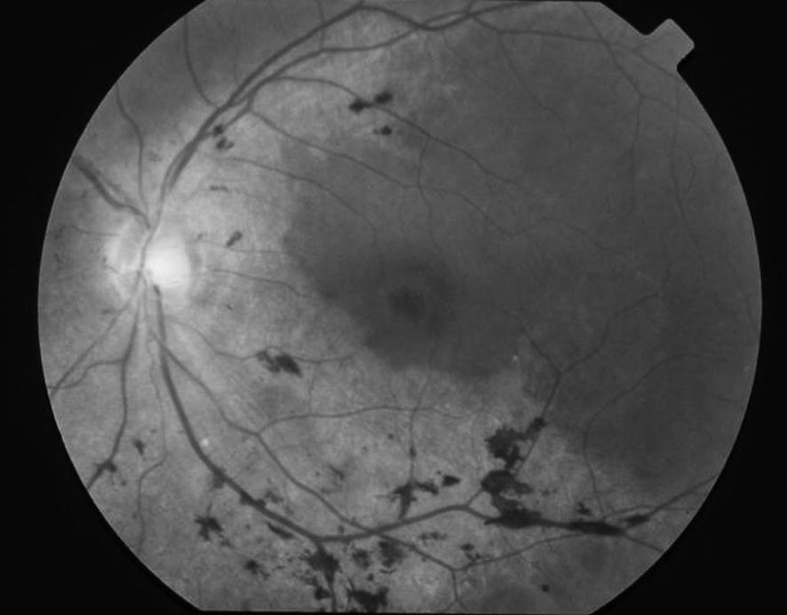 Na região inferior da retina do olho esquerdo foi observado uma lesão tipo colobomatosa com aproximadamente 6 DP (diâmetros papilares) com áreas adjacentes de cicatrização difusa.