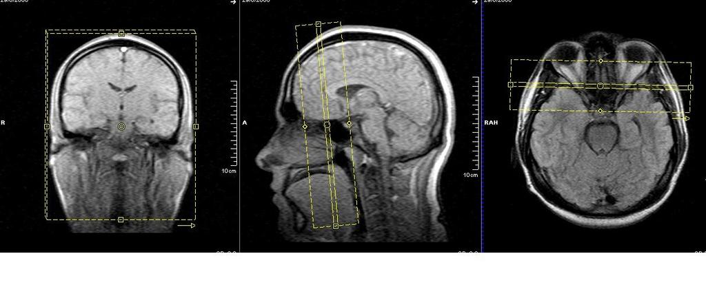 stir Coronal t1 fat sat Axial t2 Axial t1 Axial t1 fat sat