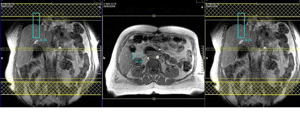 Coronal gre3d fat sat contraste Axial gre3d fat sat tardio ROTINA COLÂNGIO 1. 2. 3. 4. 5. 6.