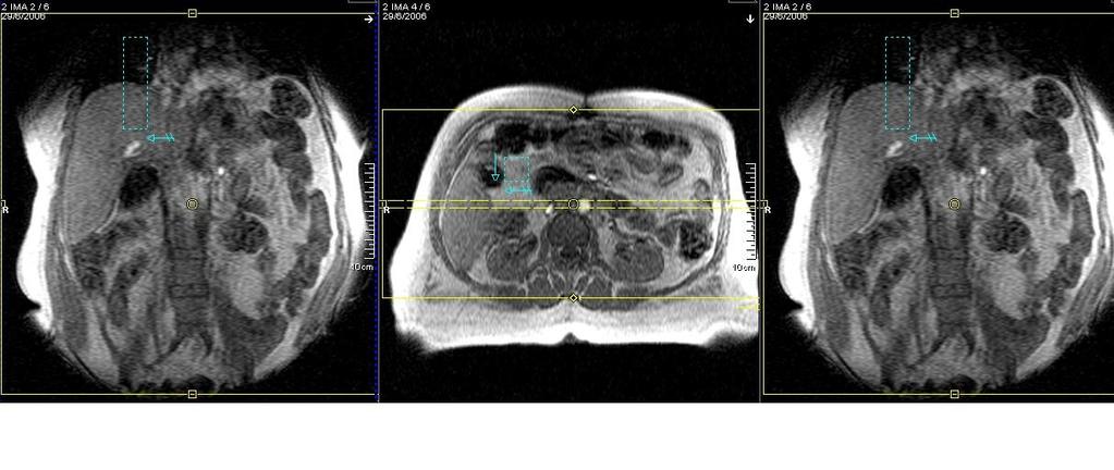 seqüências com uso de compensação respiratória ou single shot para pacientes não colaborativos PROGRAMAÇÃO PLANO AXIAL Cortes