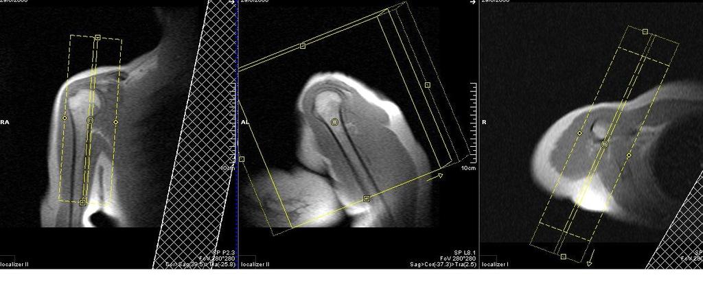 varrendo da art. acrômio clavicular até a cápsula articular.