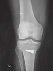 G.L. CAMANHO, L.F. CAMANHO & A.C. VIEGAS INTRODUÇÃO O ligamento cruzado anterior (LCA) é o mais acometido nas lesões do joelho, sendo responsável por 50% das lesões ligamentares do joelho (1).