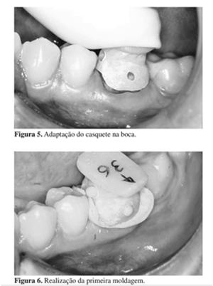 polissulfetos» água (PEMLASTI - Kerr) silicone de condensação»