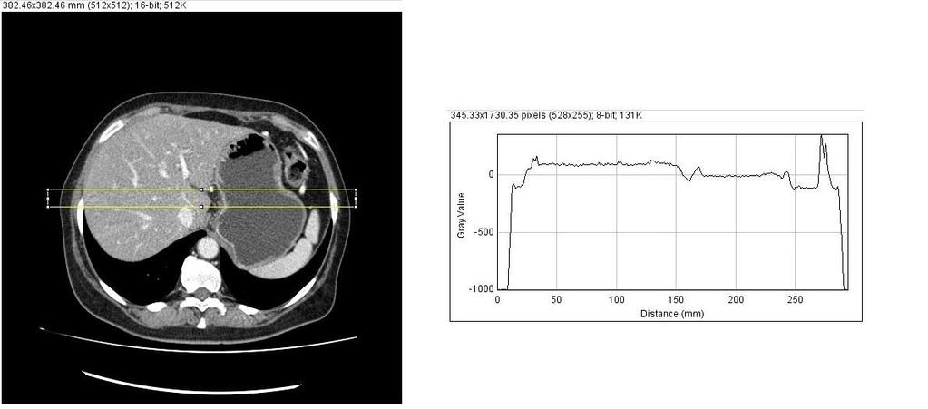 62 Processamento automático de imagens DICOM para otimização de doses em exames de Tomografia Computorizada Com o processador de imagens baseado em linguagem JAVA,ImageJ, a janela é corretamente