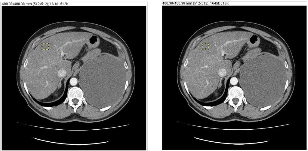 80 Processamento automático de imagens DICOM para otimização de doses em exames de Tomografia Computorizada Figura 41 - À esquerda: imagem clínica do 3º Doente adquirida a 291 ma com corte localizado