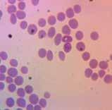 Capítulo 4 Protocolos para diagnóstico de babesiose e anaplasmose 79 6. A identificação da lâmina deve ser feita com lápis na extremidade espessa do esfregaço. 7. Fixar o esfregaço mergulhando a lâmina em metanol por 5 minutos.