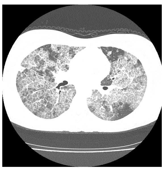 inflamatório em atividade ou fibrose