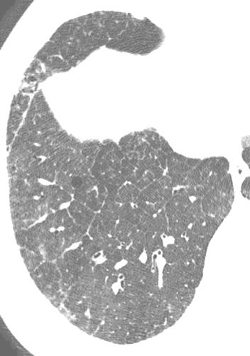 PNEUMONIA INTERSTICIAL DESCAMATIVA