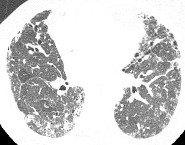 há 10 anos Neoplasia