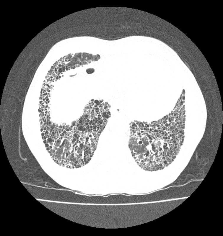 Predominância subpleural e basal 2. Infiltrado reticular 3.